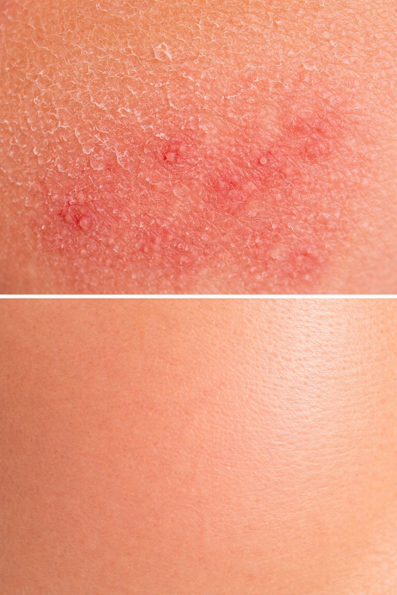 Skin Dryness