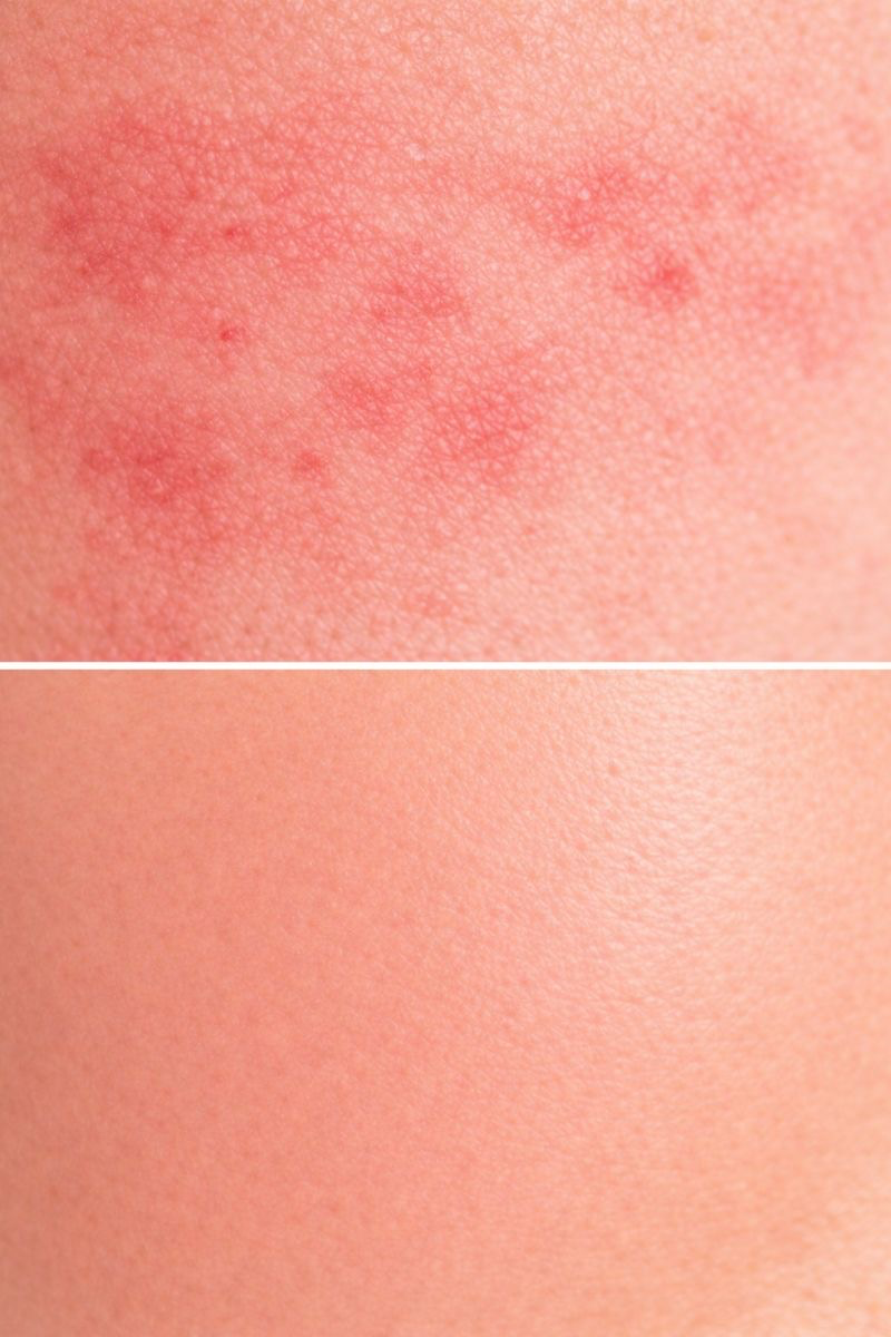 Skin Irritation
