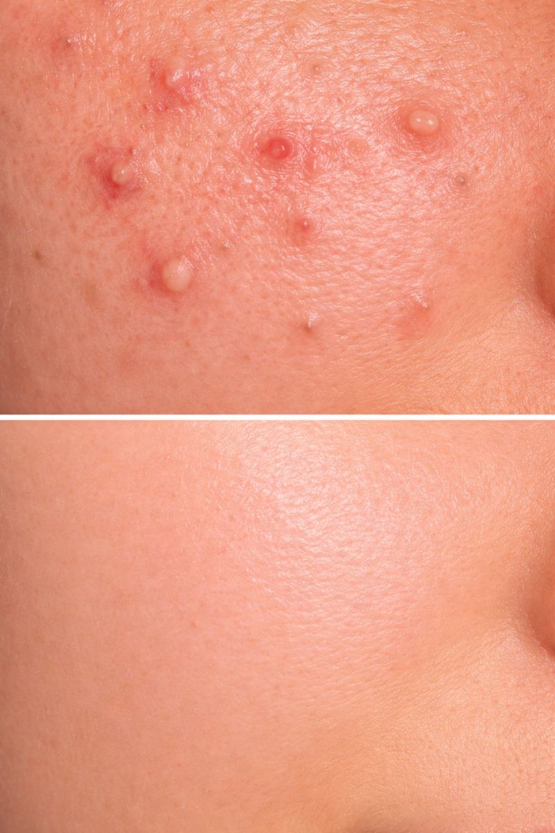 Breakouts